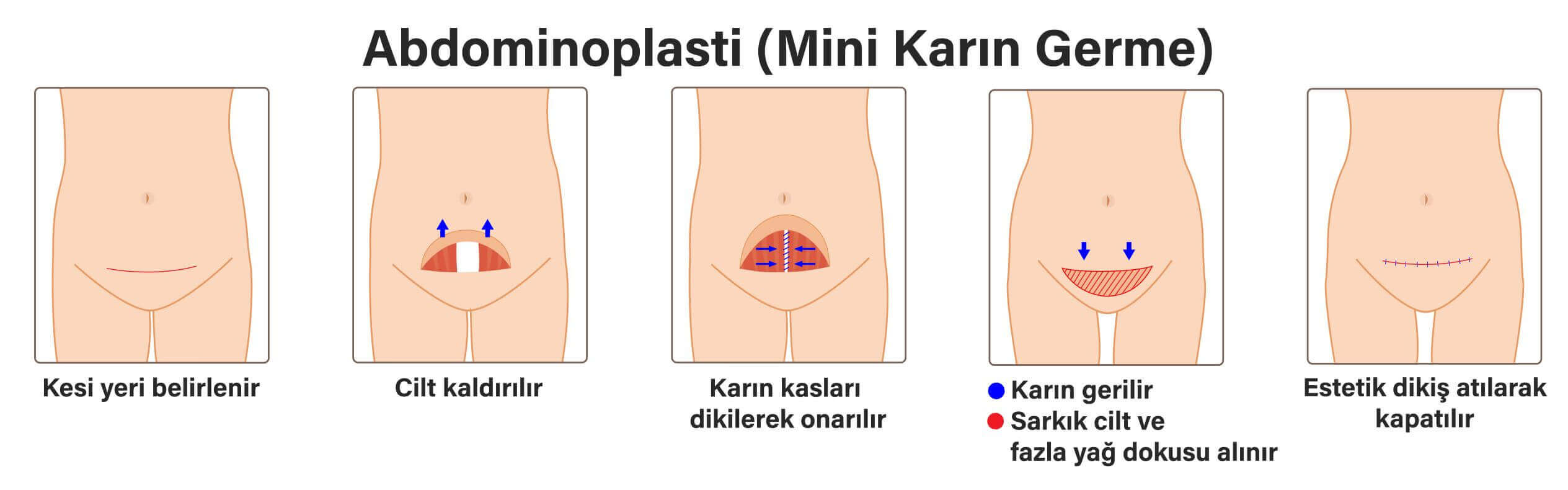 karın germe ameliyatı olanların yorumları