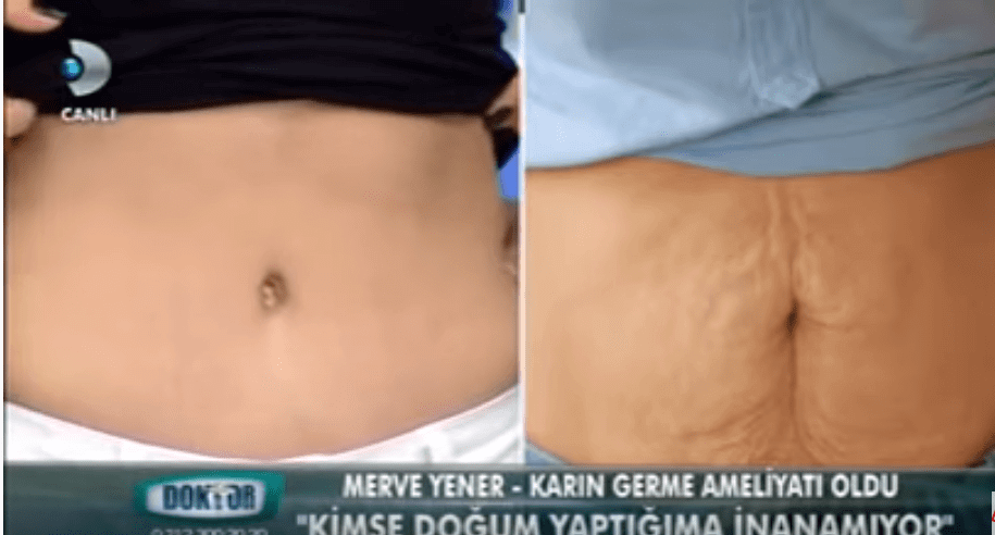 karın germe önce sonra