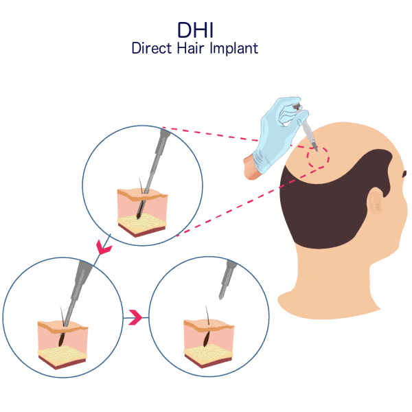 DHI-Hair-TransplanT