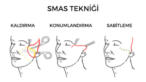 smas tekniği