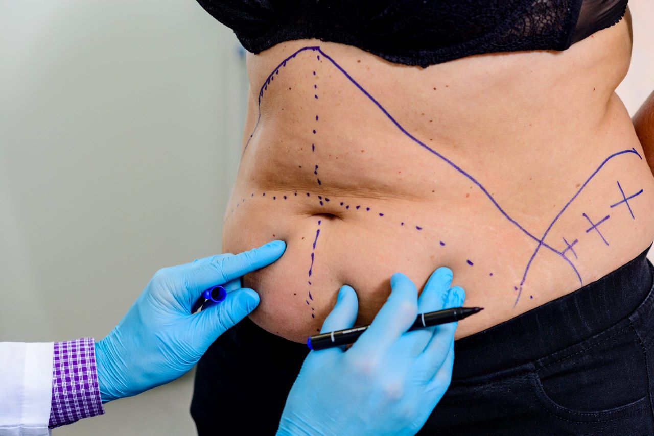 Vaser Liposuction ile Klasik Liposuction