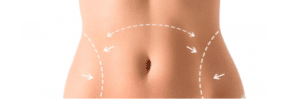 liposuction vücut şekillendirme