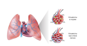 Pulmoner Ödem