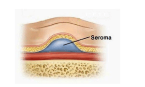 Seroma