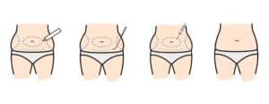liposuction-