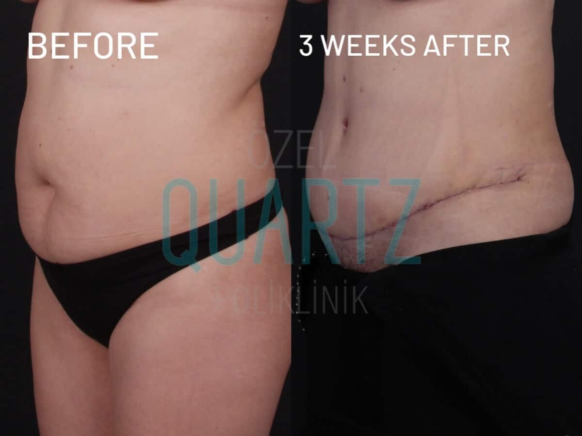 Tummy Tuck