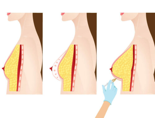 Was sind die Vor- und Nachteile einer Brustvergrößerung mit Eigenfett?