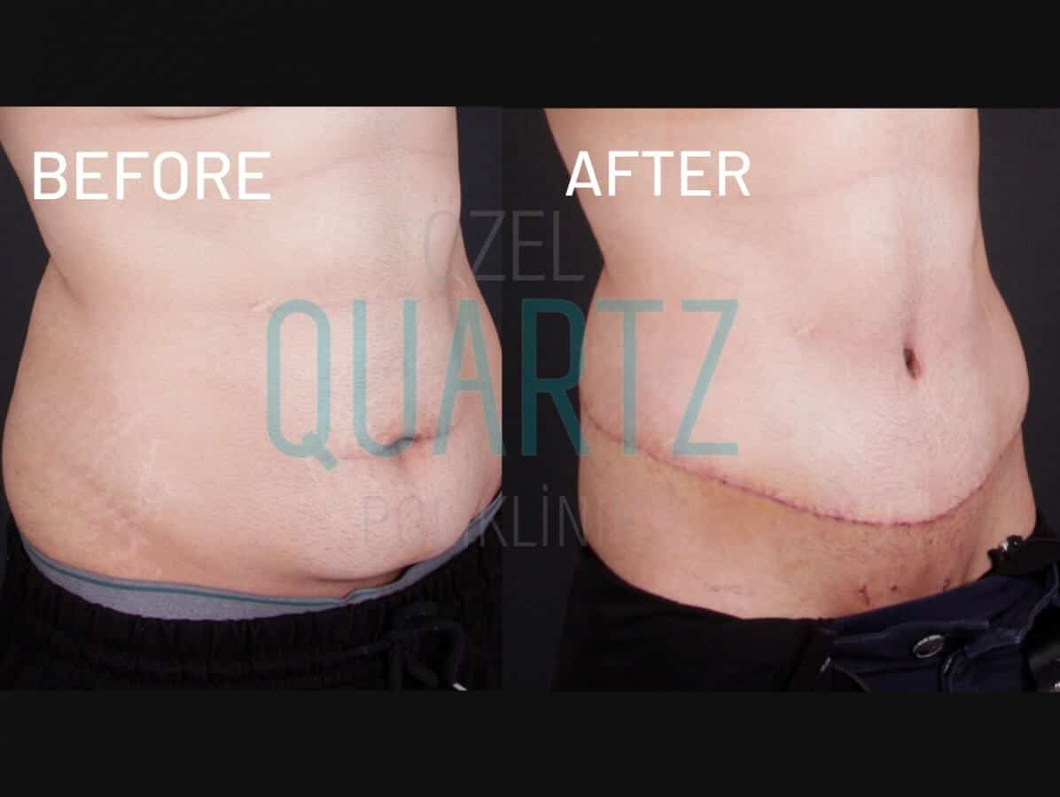 Tummy Tuck