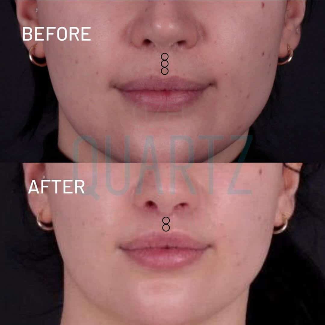 lip lift