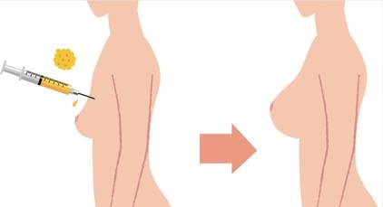 Fat Transfer Breast Enlargement