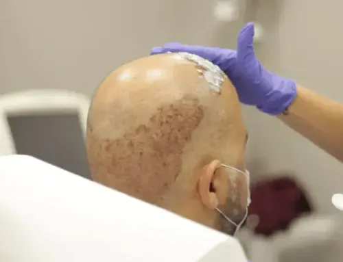 Wie Wäscht man Sich Nach der Haartransplantation die Haare?