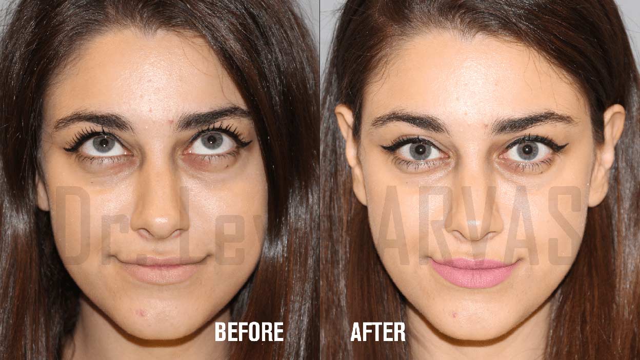 Under eye fillers before after 2