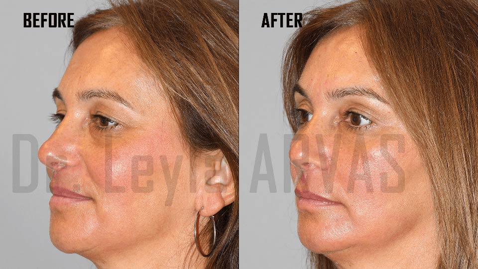 Under eye fillers before after