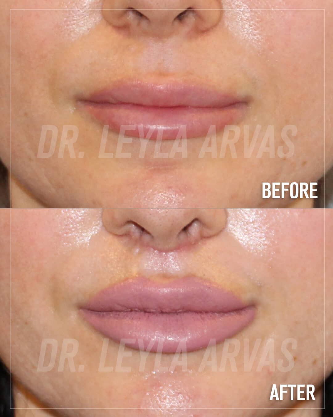 Lip Lift