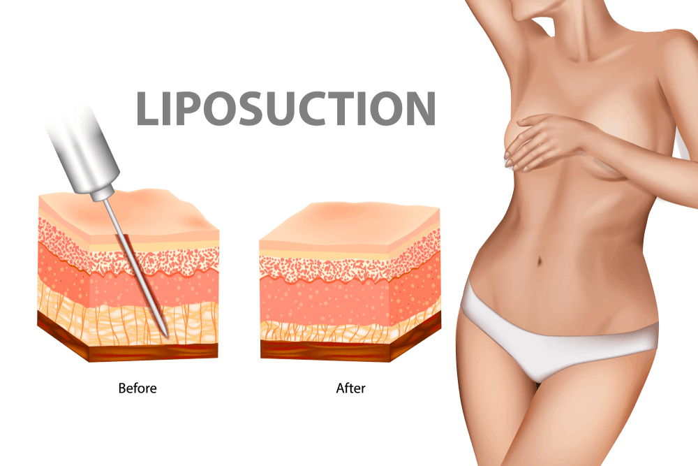 Liposuction - Price - Istanbul, Turkey - Op. Dr. Leyla Arvas