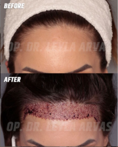 Stirnverkleinerung mit Haartransplantation bei Frauen