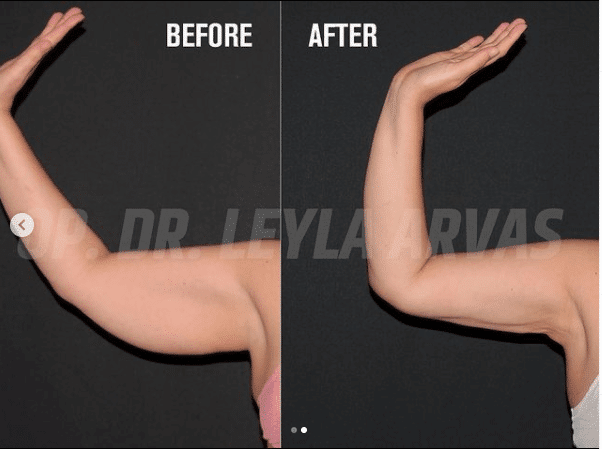 Arm Lift (Brachioplasty)