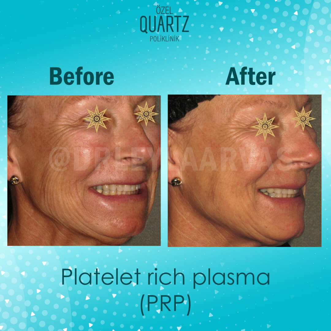 PRP (Platelet-Rich Plasma)