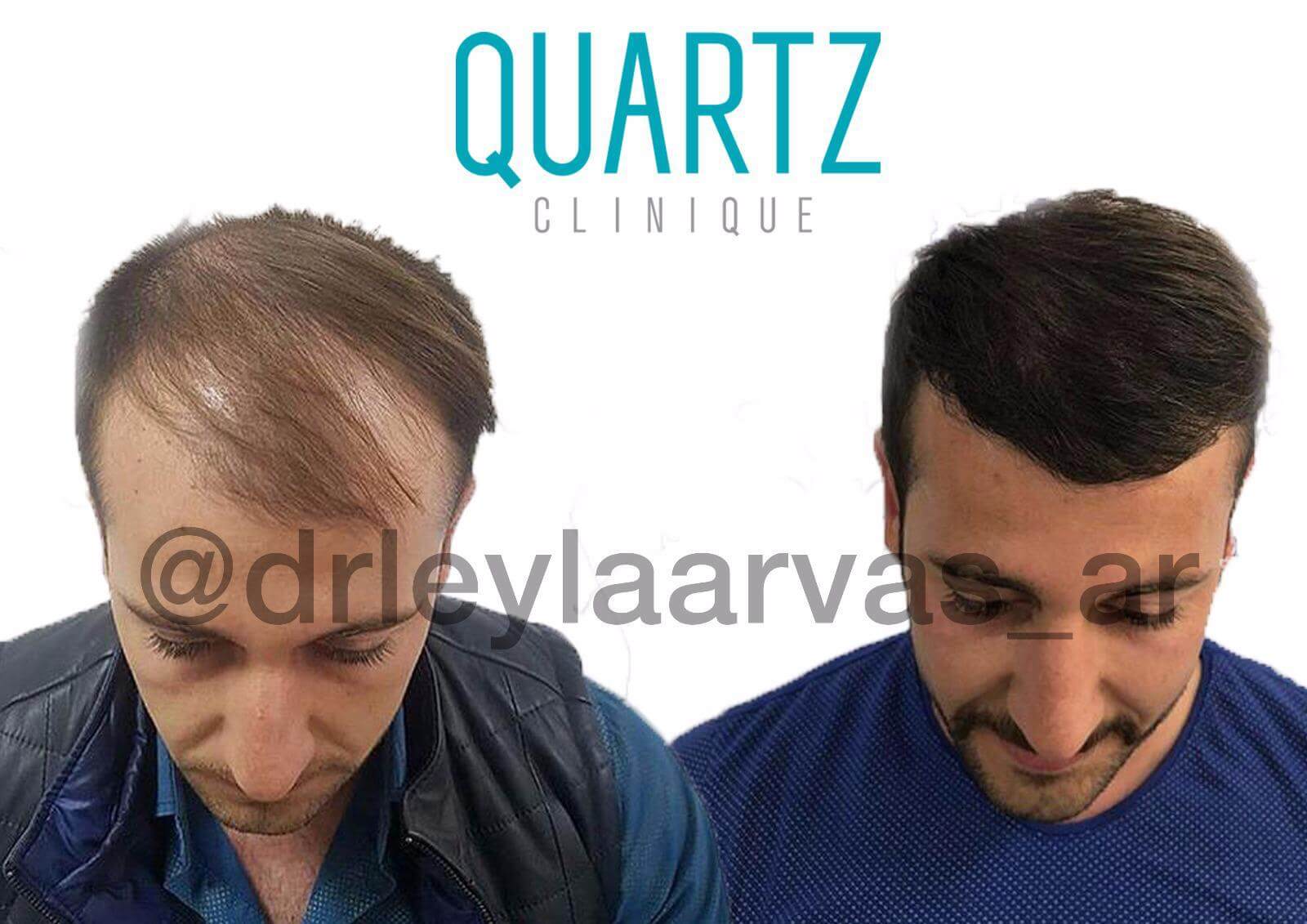 Hair Transplantation