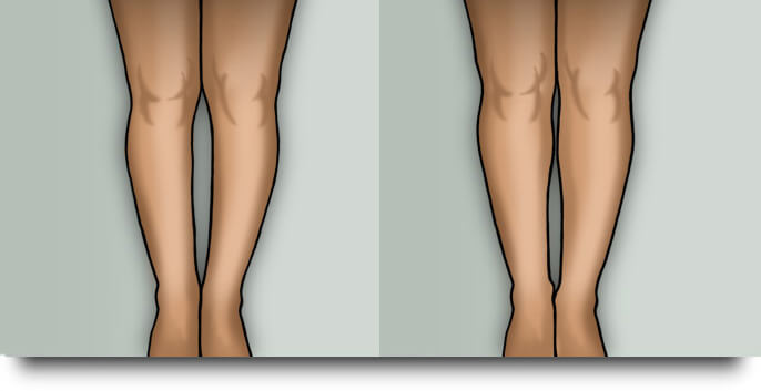 carpık bacak estetiği 2