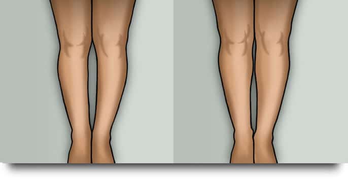 Çarpık Bacak Estetiği | 2024 Fiyatları - Op. Dr. Leyla Arvas