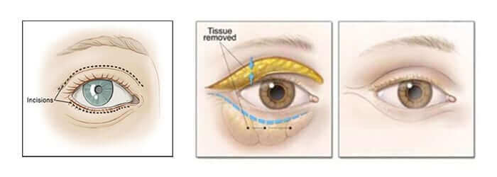 Göz Kapağı Ameliyatı Nasıl Yapılır