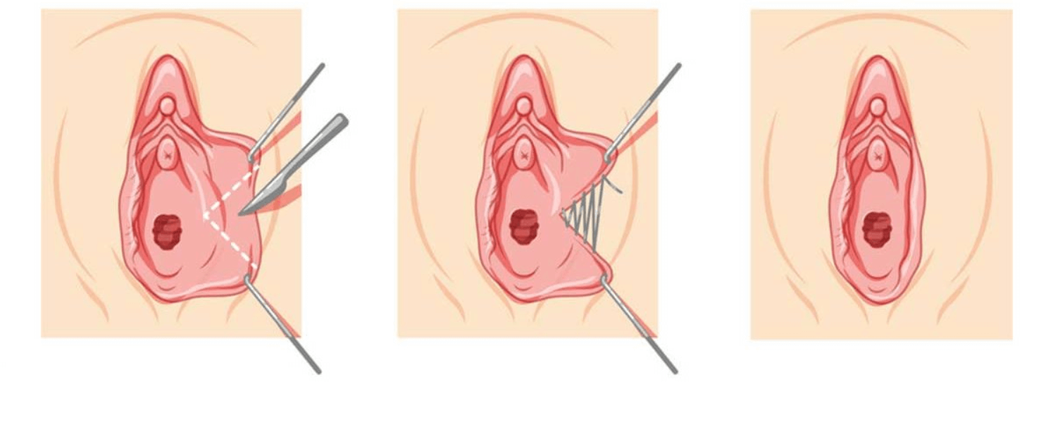 Labioplasti Ameliyatı 1