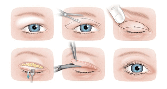 Üst Göz Kapağı Ameliyatı Nedir
