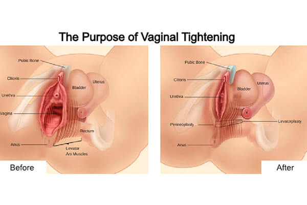 vajina daraltma estetiği