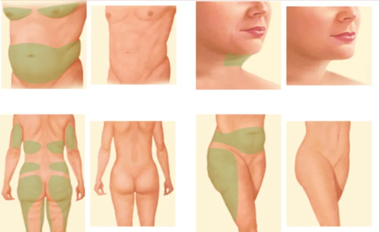 Liposuction Nereye Yapilabilir 768x472.png1 1