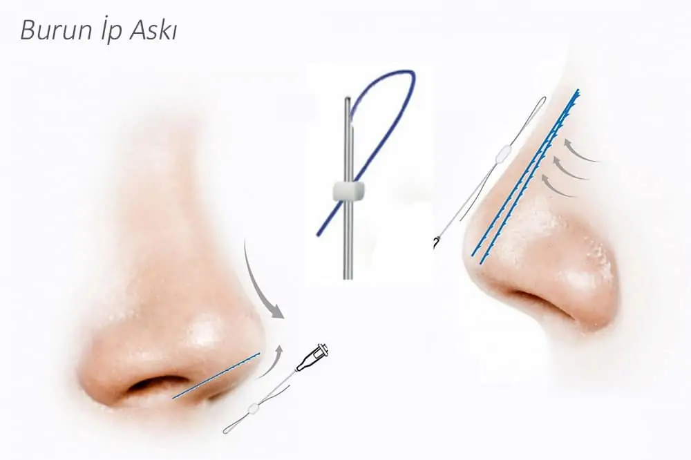 Burun İp Askı Burun İp Askı