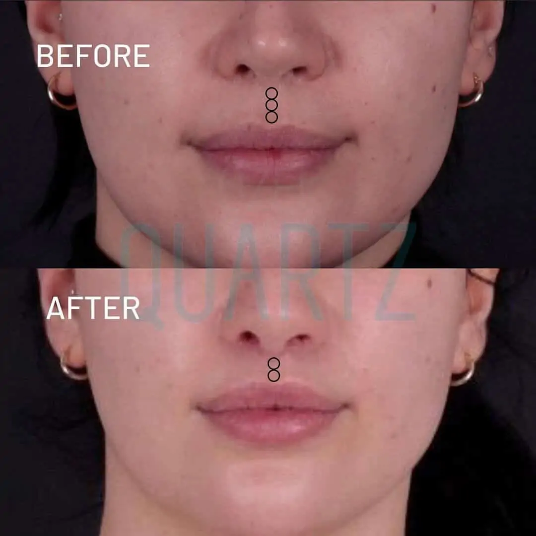 lip lift