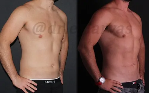Liposuccion Vaser Hi Def