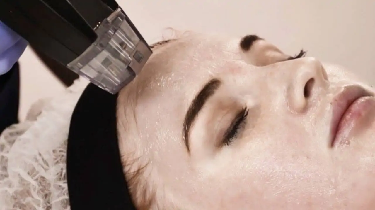 Microneedling
