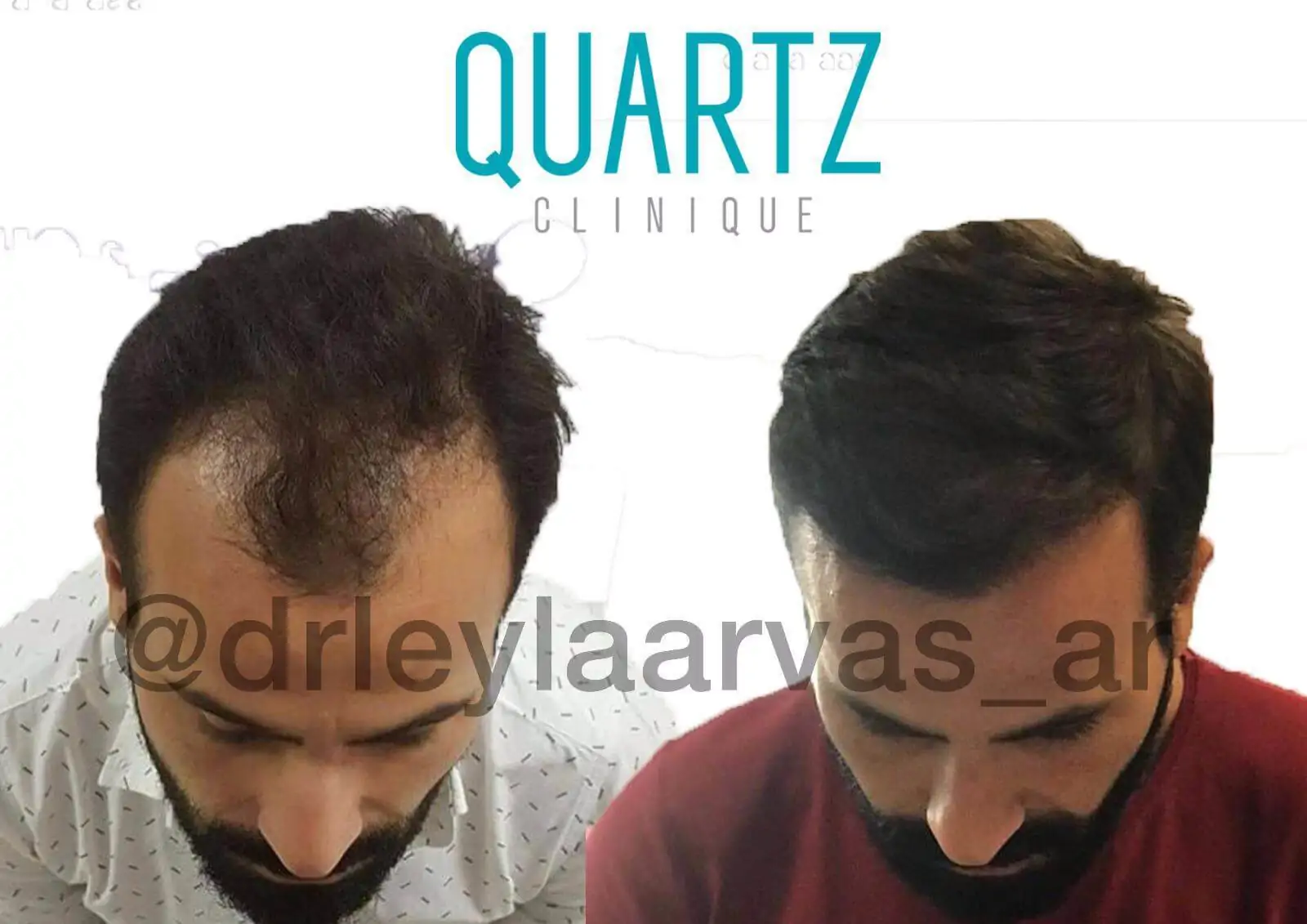 Hair Transplantation