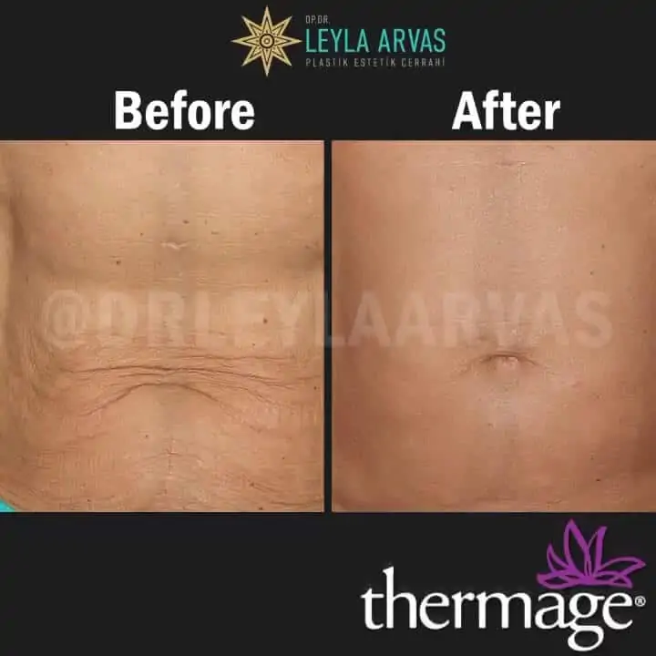Body Lift avec Thermage Body