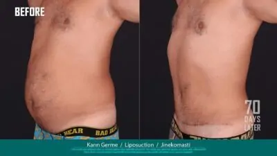 Karin Germe Liposuction Jinekomastil
