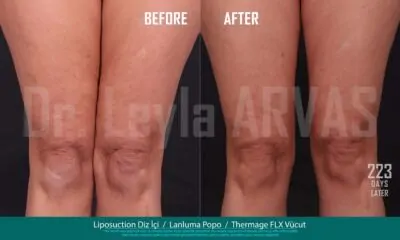 Liposuction Dizici