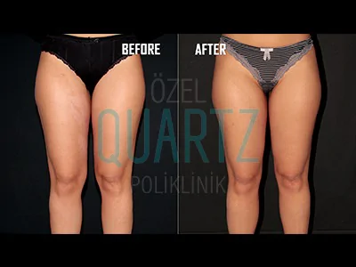 bacak liposuction