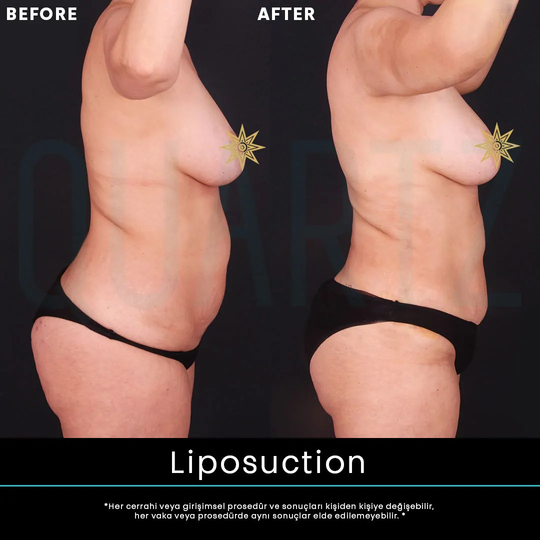 liposuction 1
