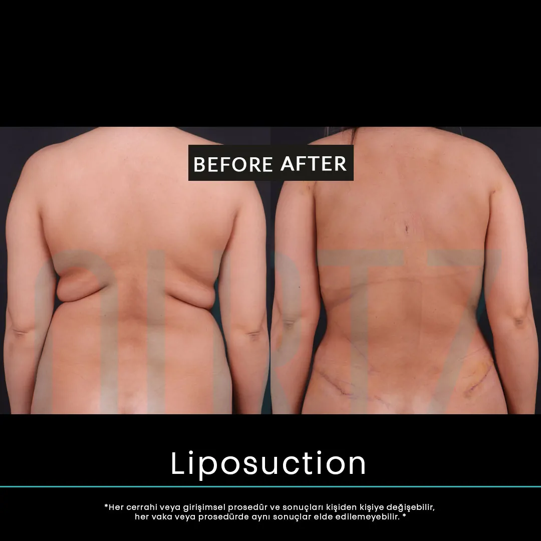 liposuction 10