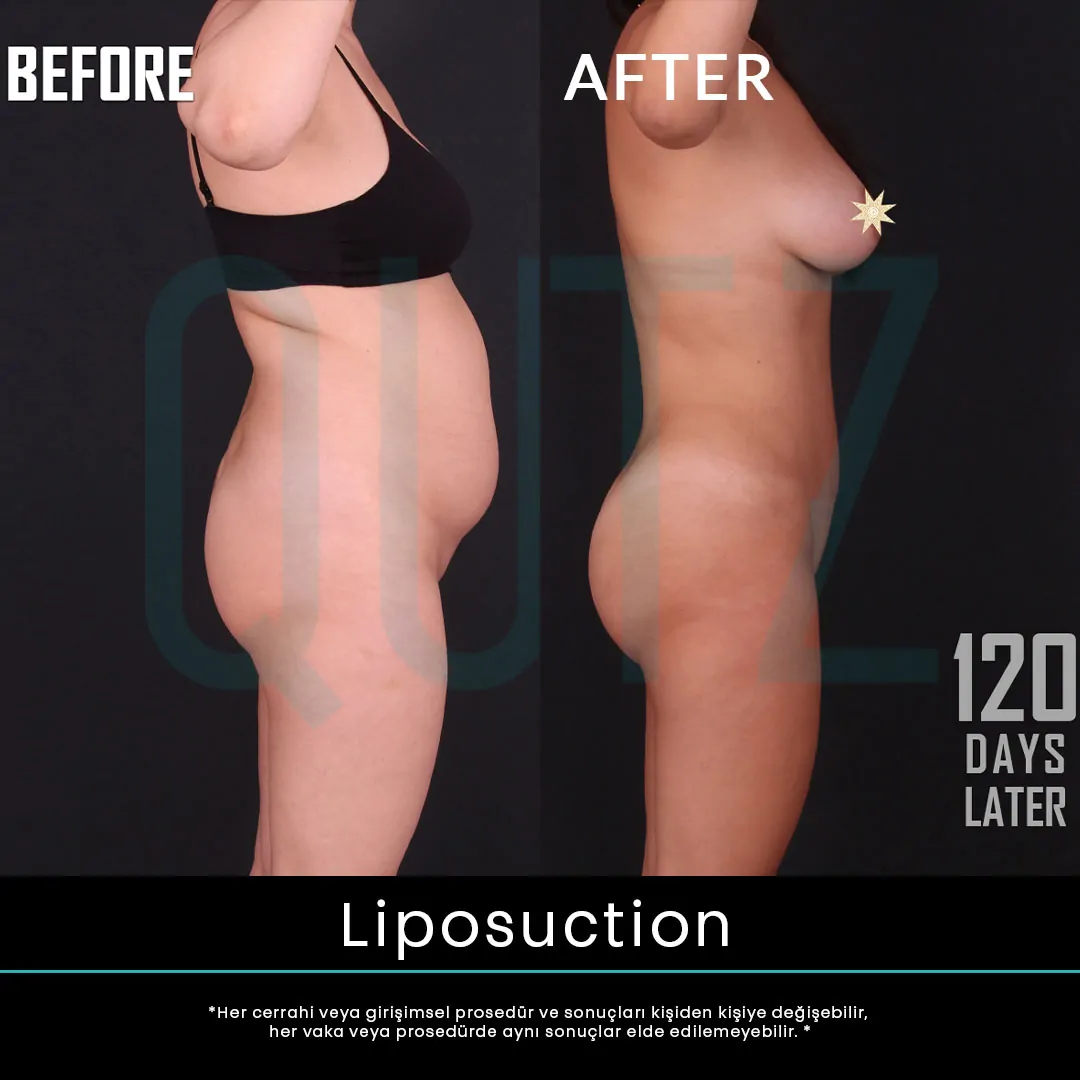 liposuction 11
