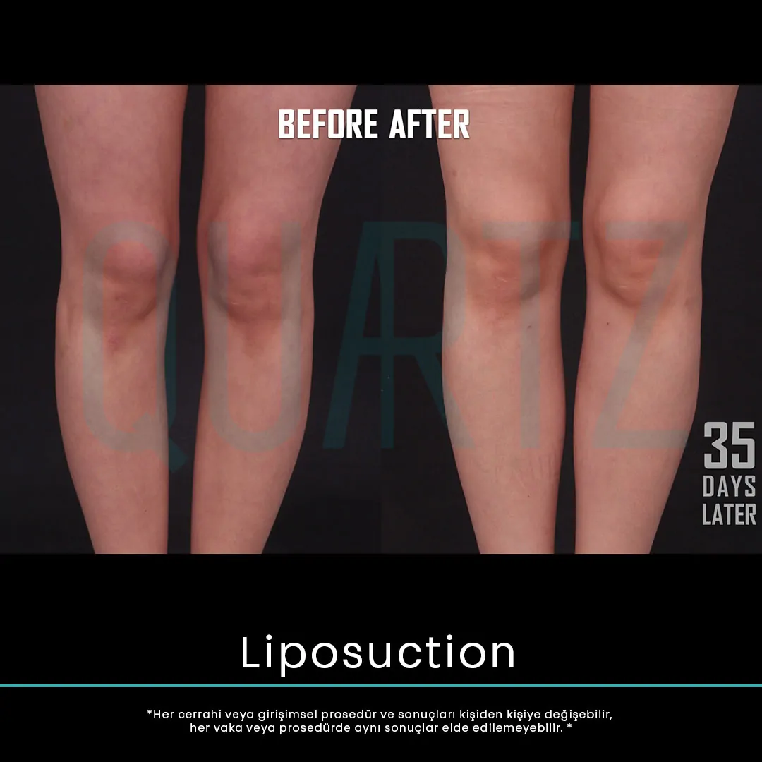 liposuction 12