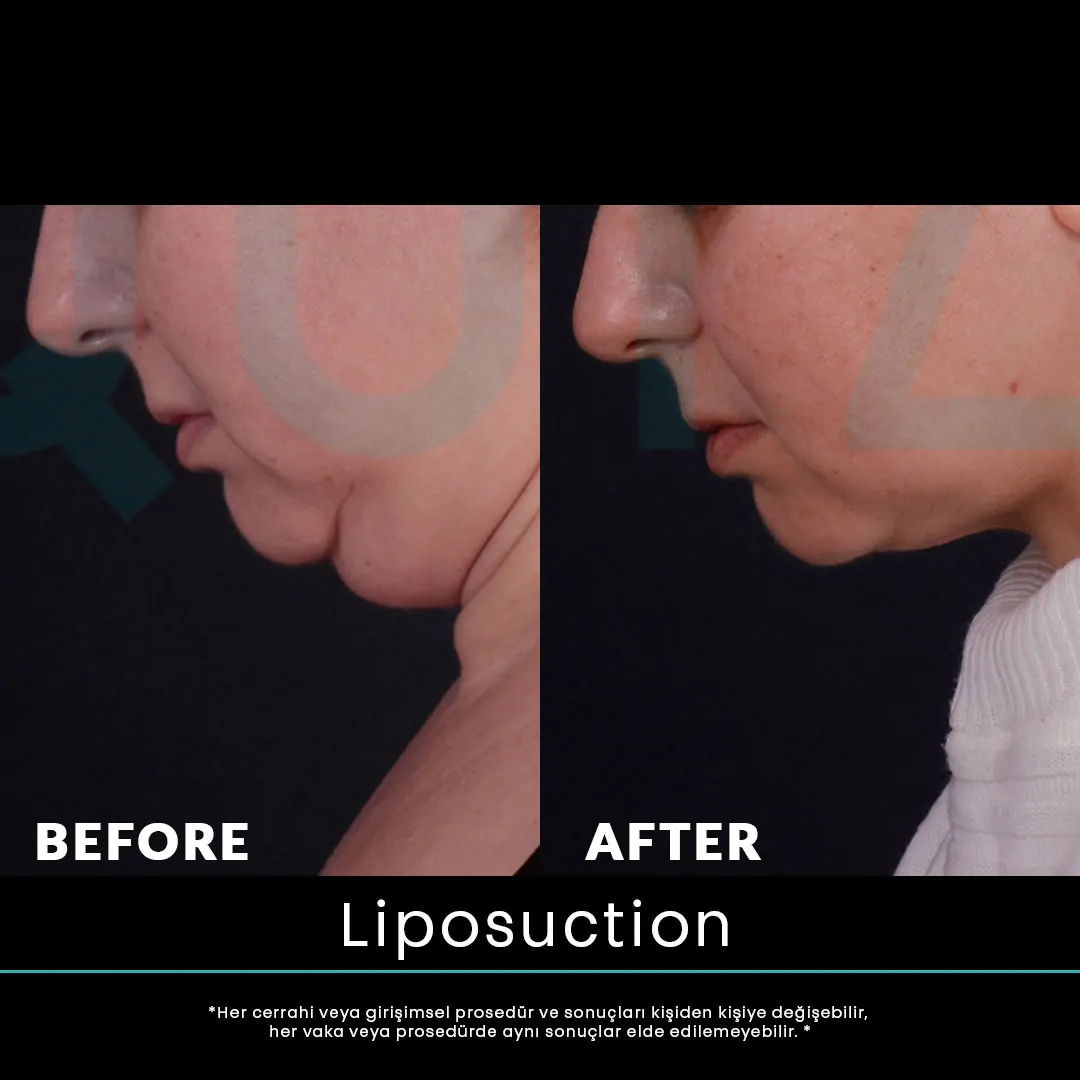 liposuction 13