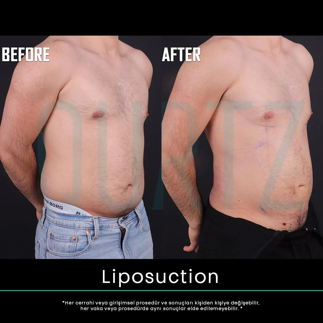 liposuction 15