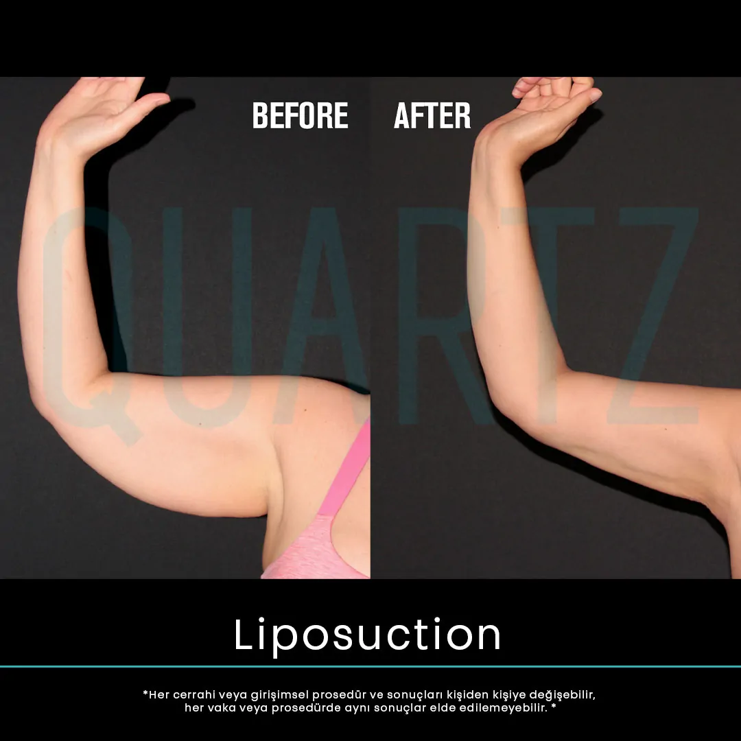 liposuction 16