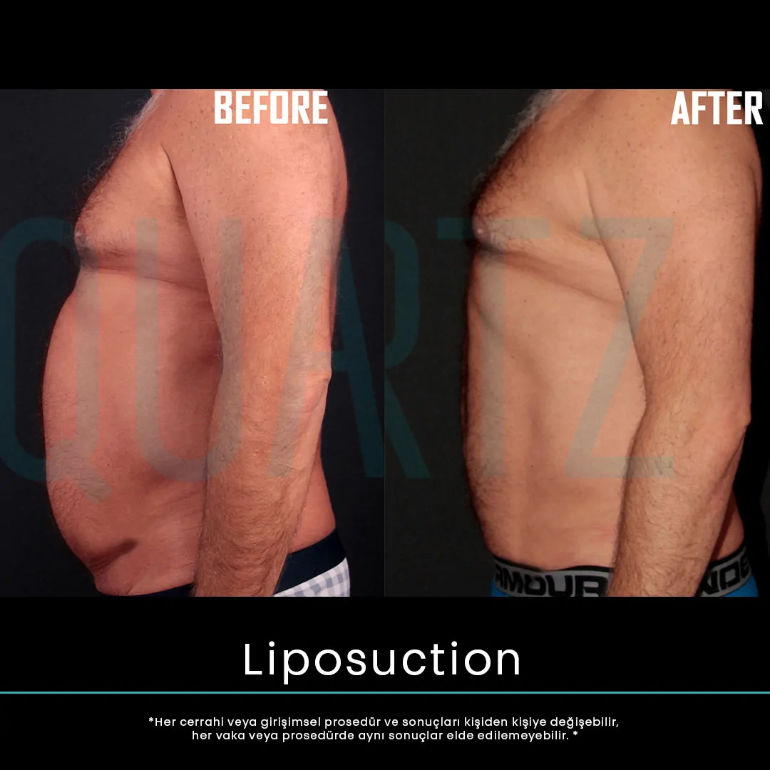 liposuction 17