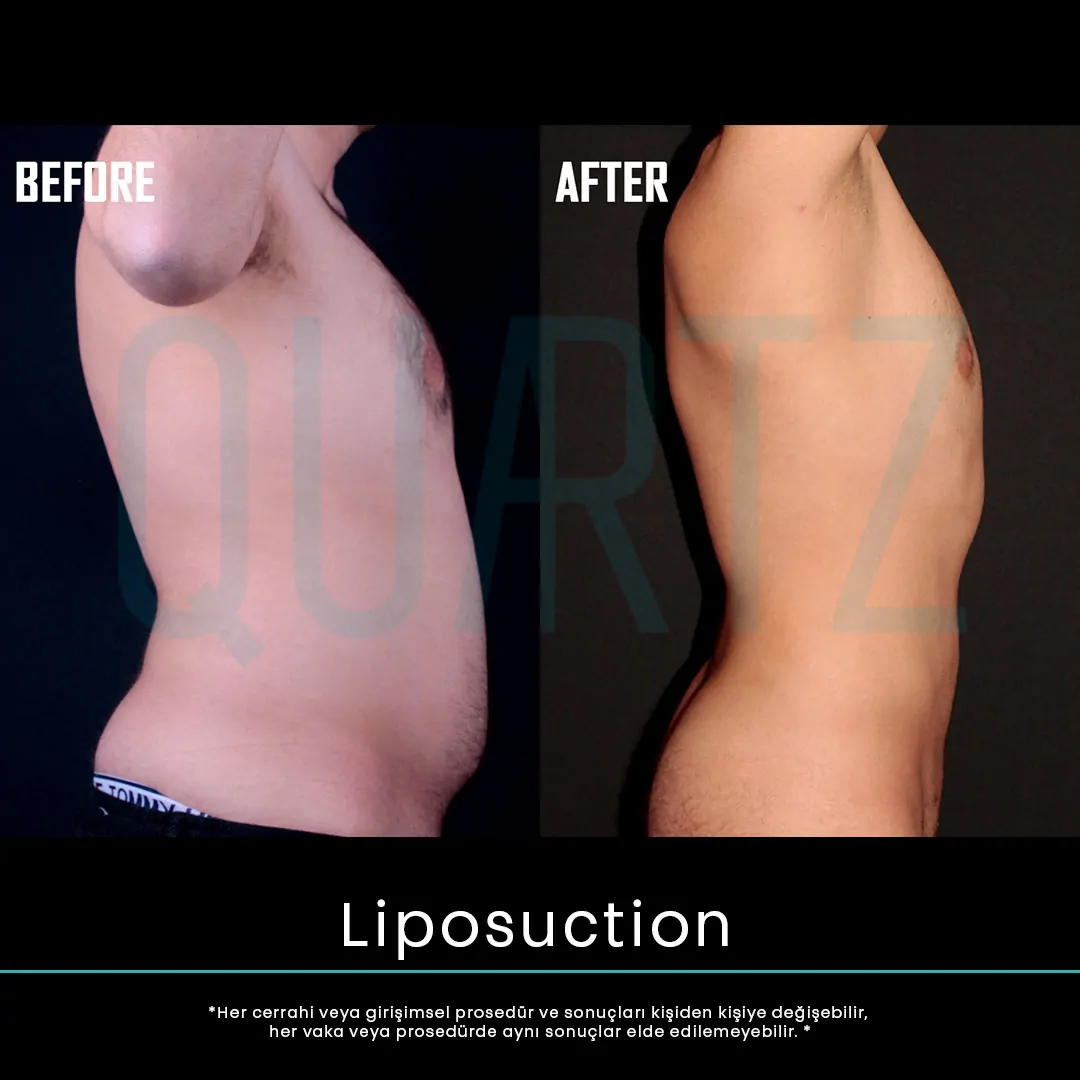 liposuction 18