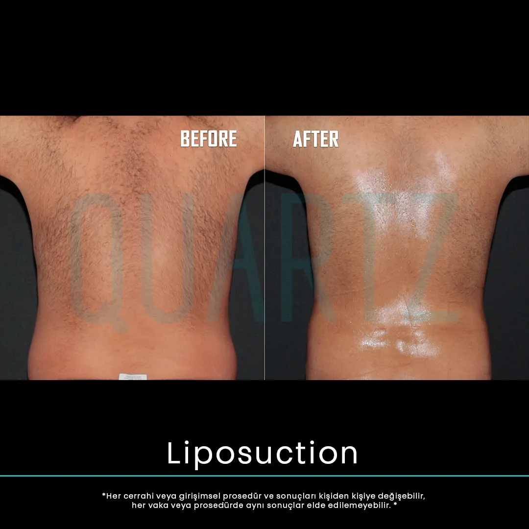 liposuction 19