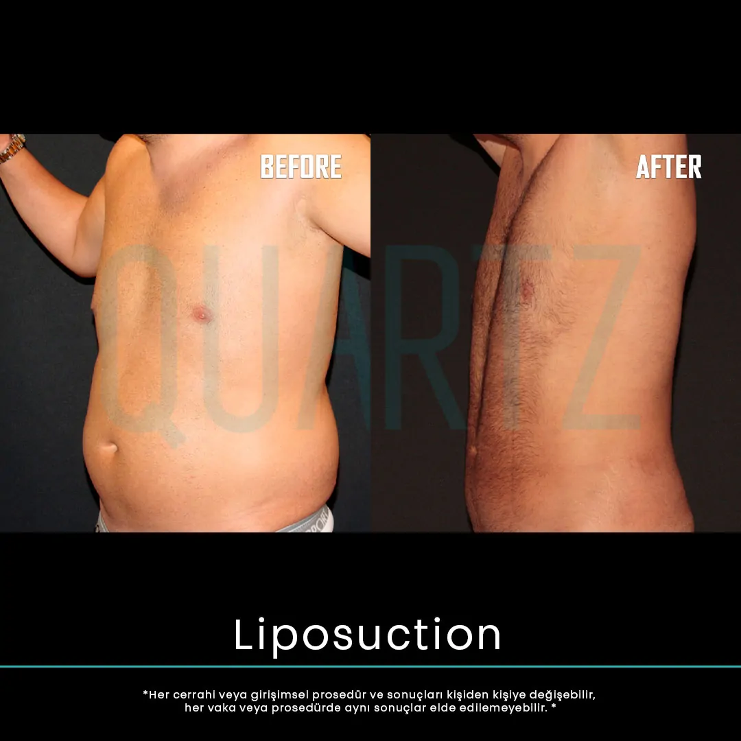 liposuction 20